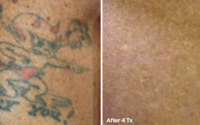 Tattoo removal before and after