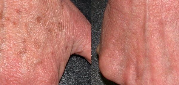 Sun spot pigmented leasion removal