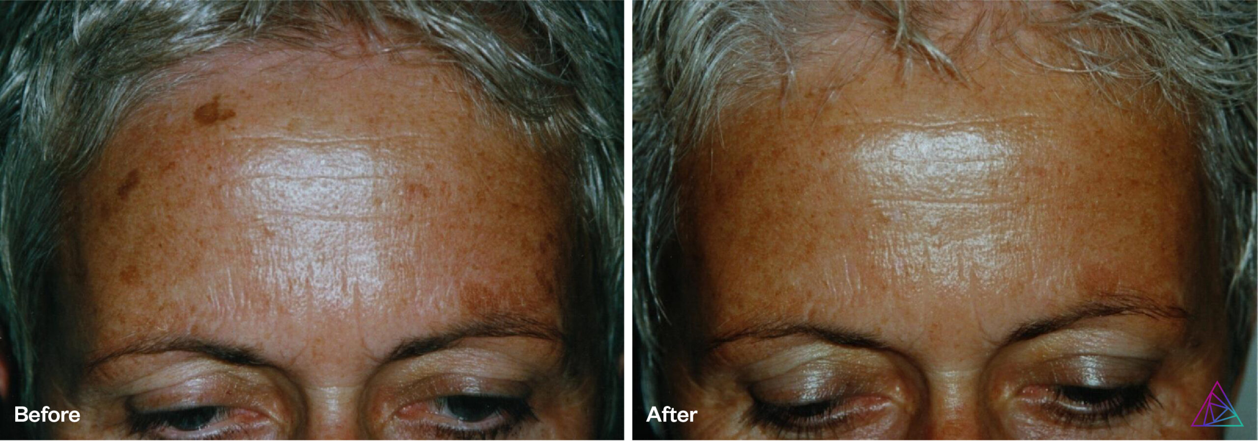 Sun spot pigmented leasion removal