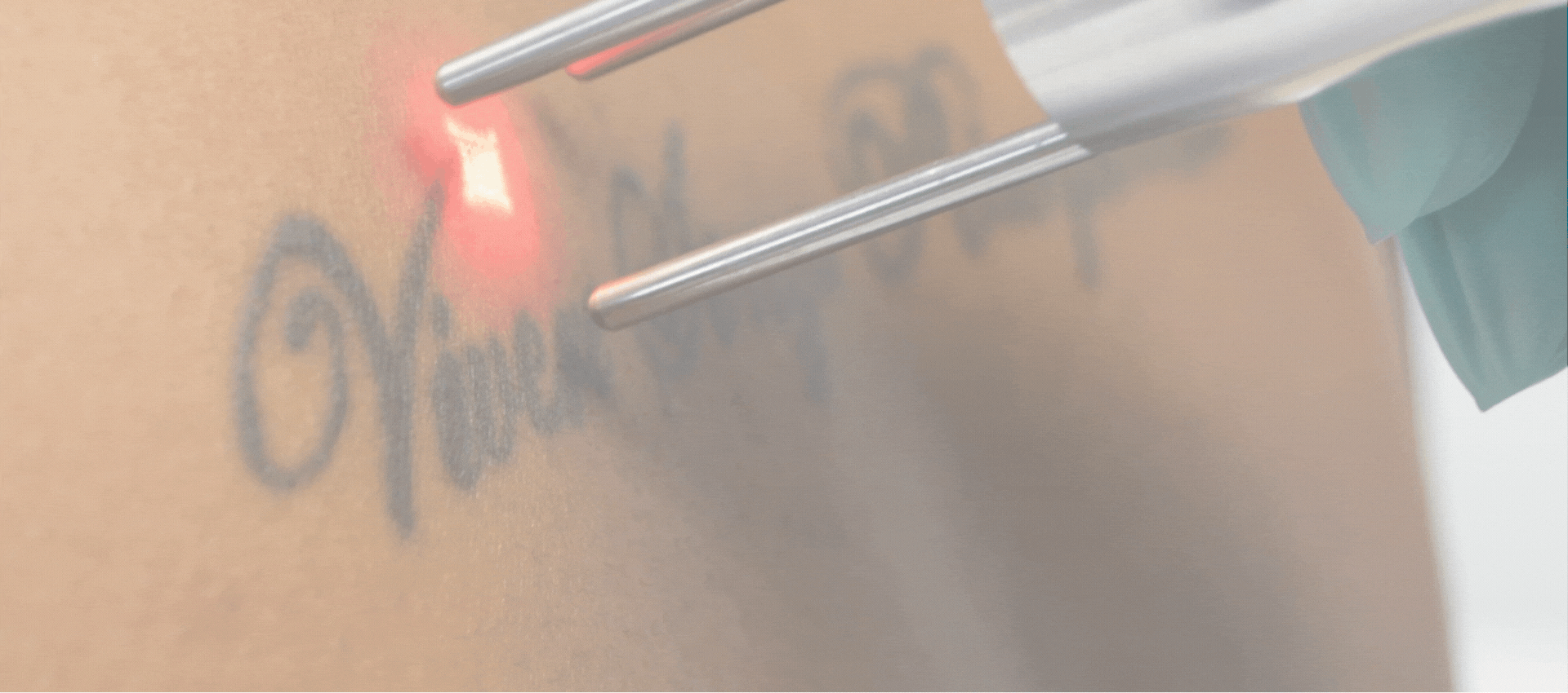 tattooremovalhero (1920 x 850 px)