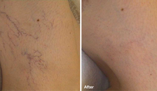 vascular lesion b&a 1