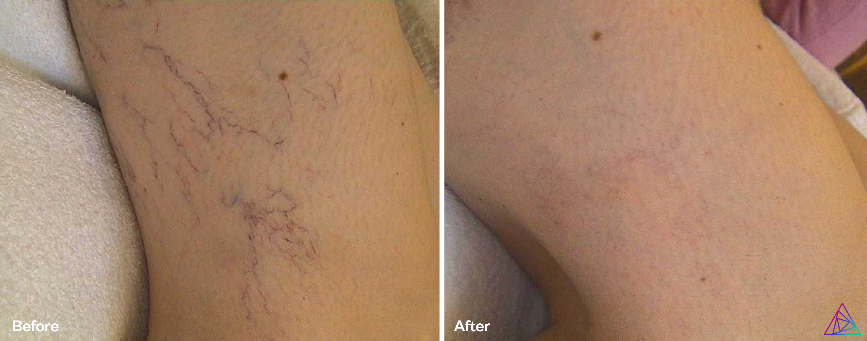 vascular lesion b&a 1