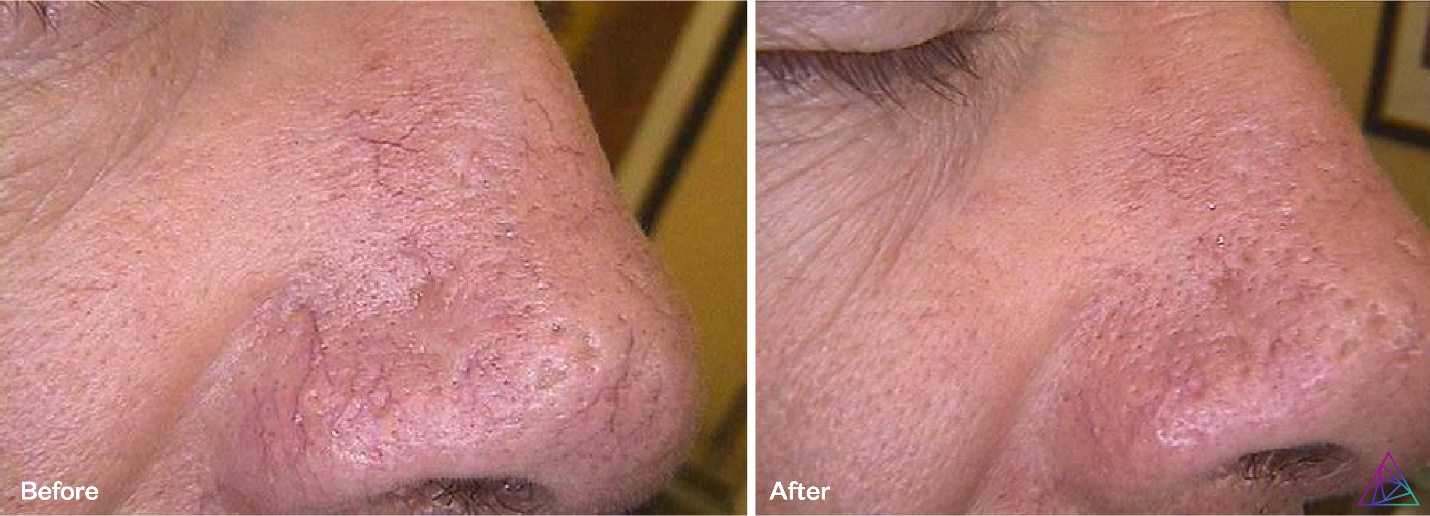 vascular lesion b&a 2