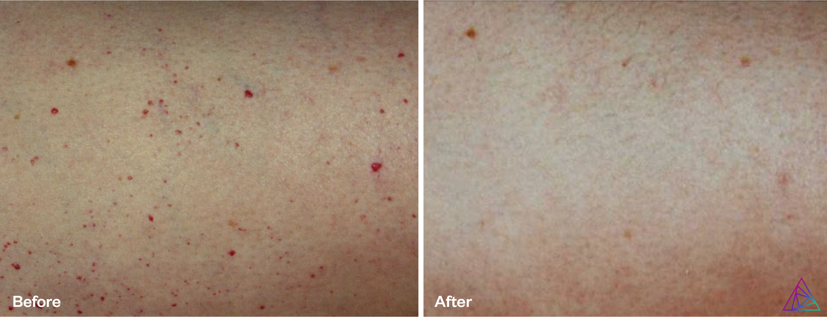 vascular lesion b&a 4