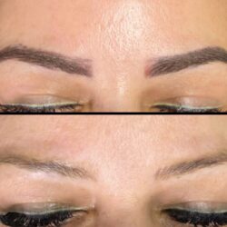 eyebrow laser removal