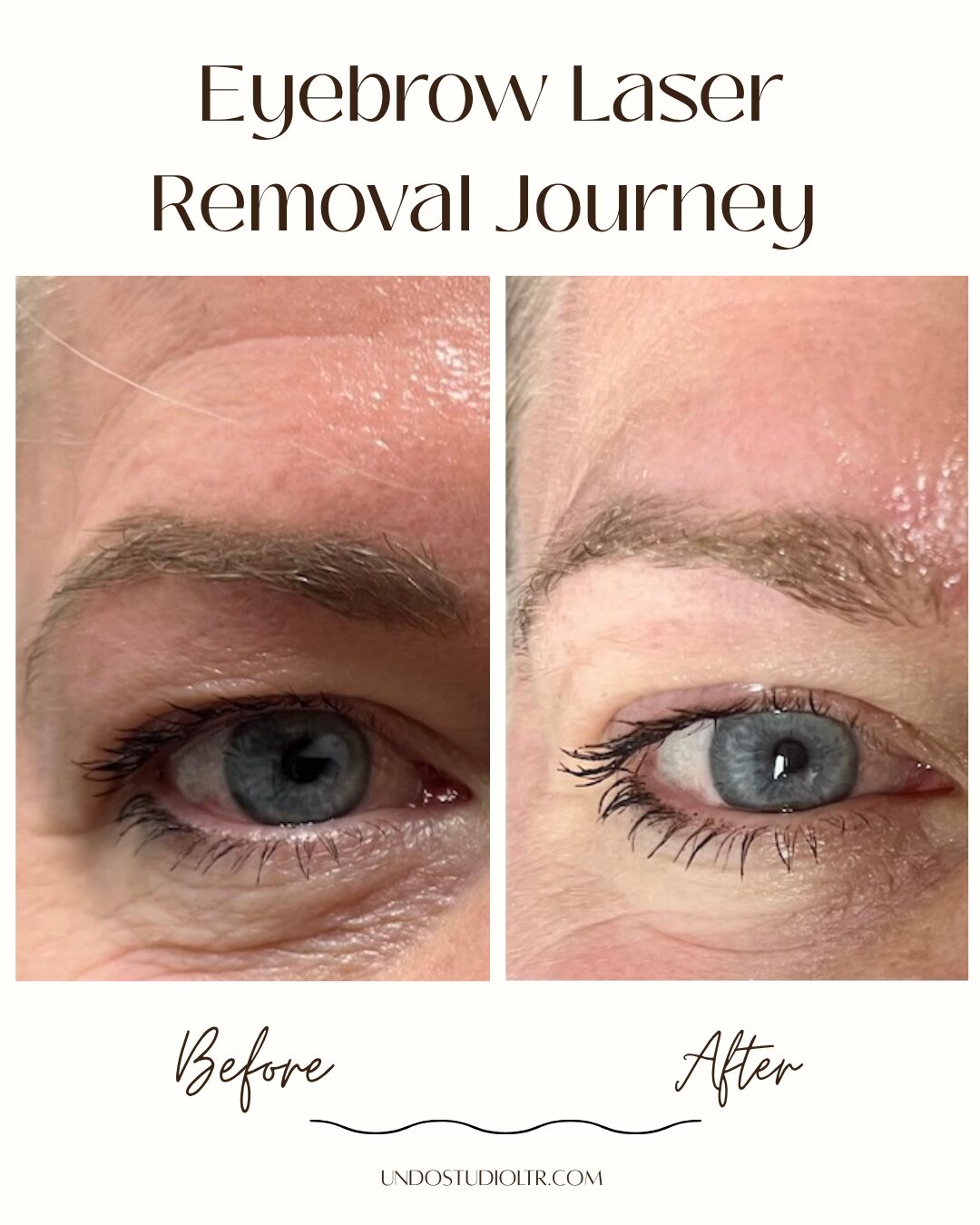 PMU removal Before and after