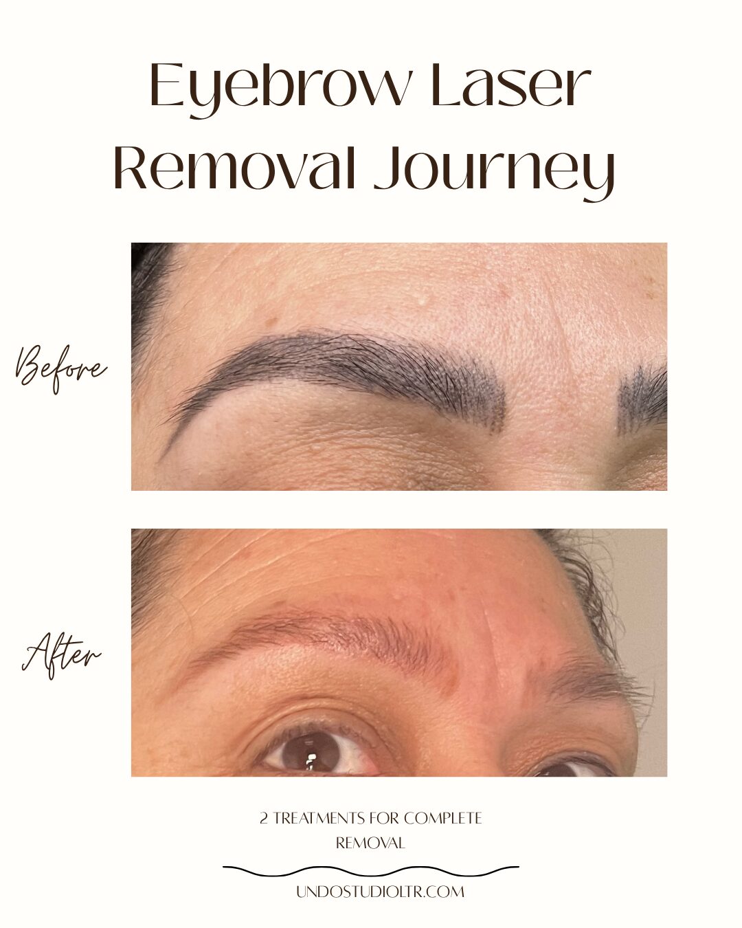 PMU Laser tattoo removal