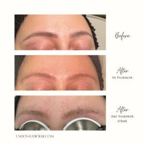 PMU Laser tattoo removal PMU Laser tattoo removal