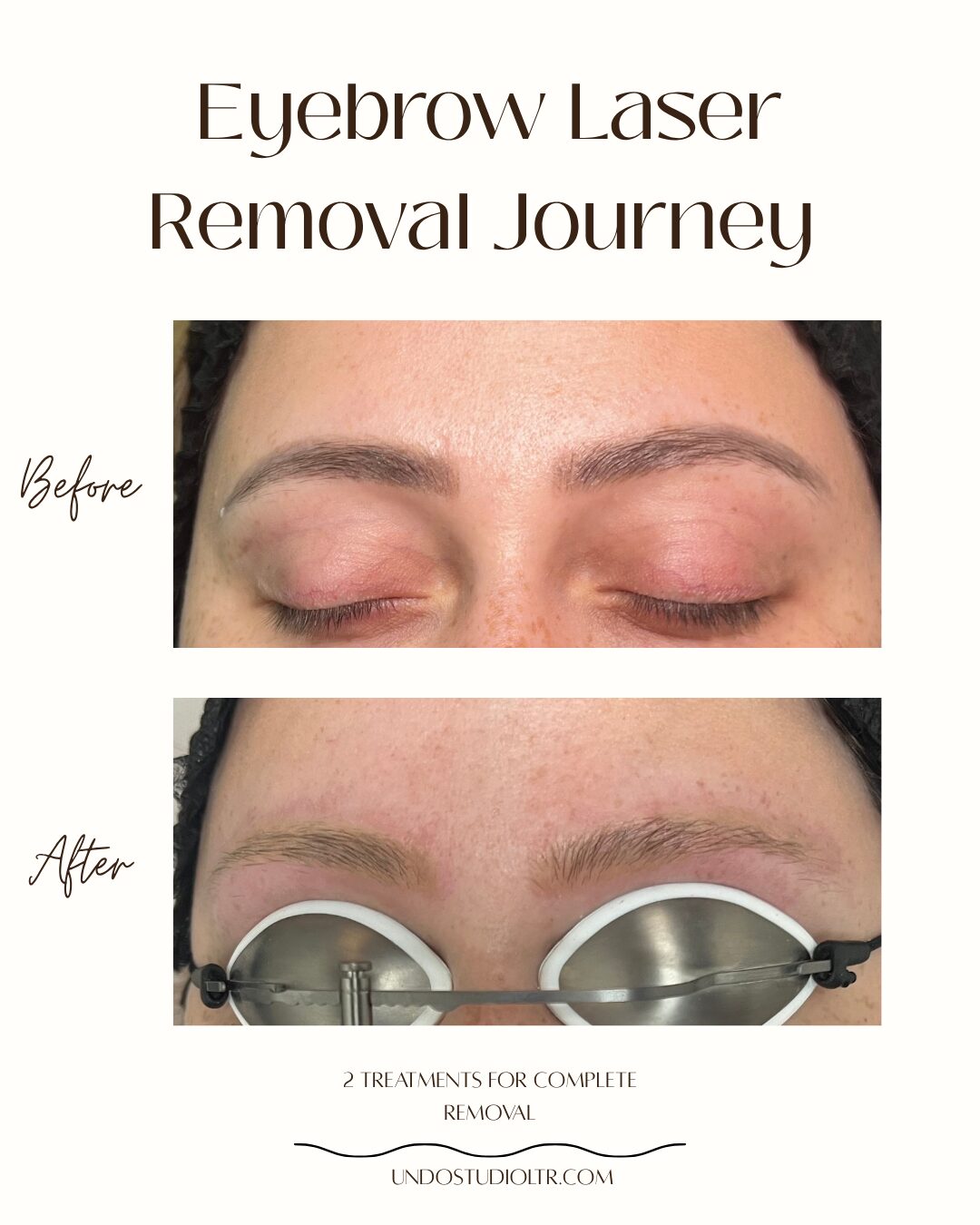 PMU Laser tattoo removal