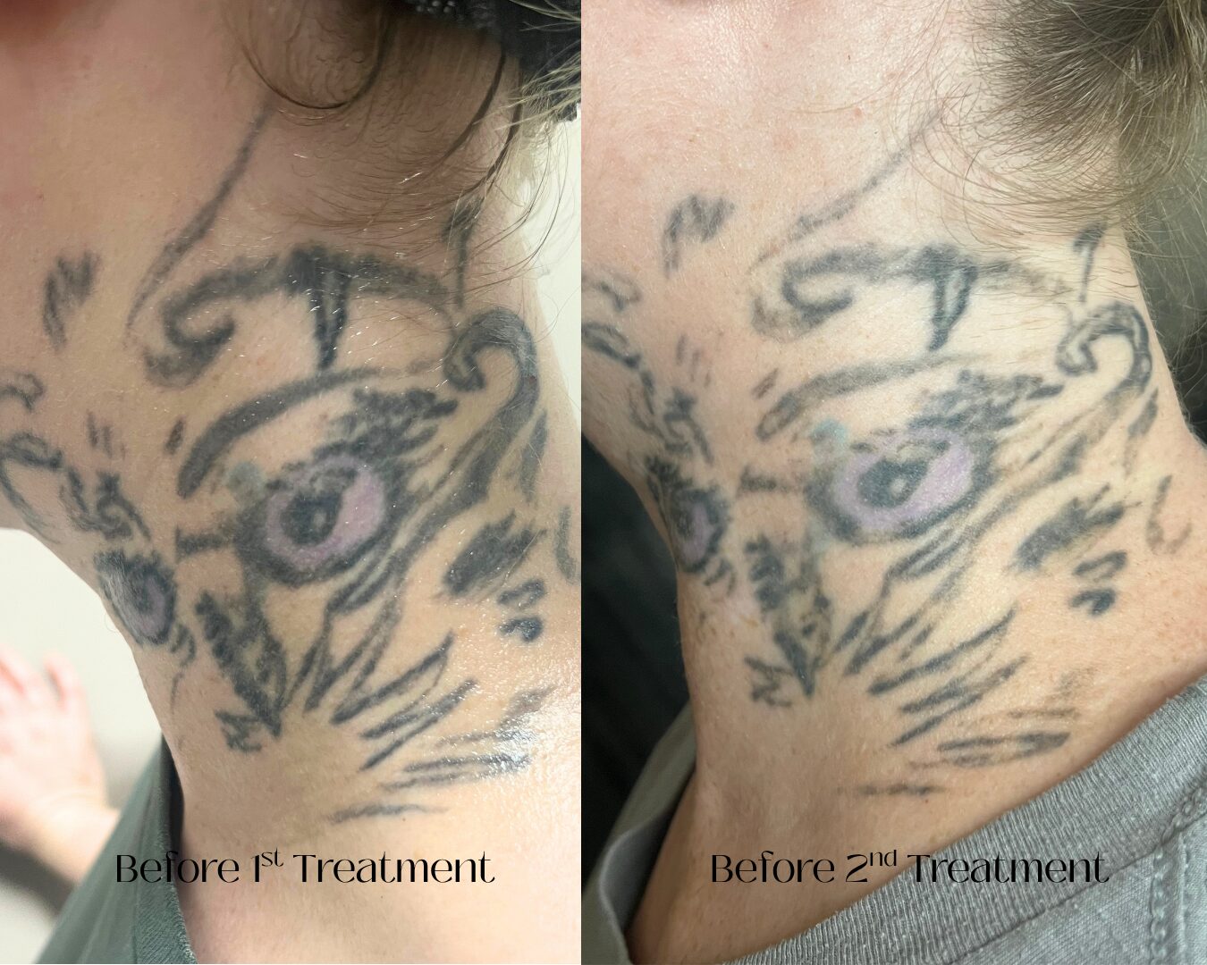 Laser tattoo removal